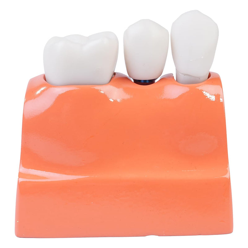 [AUSTRALIA] - Sarini Oral Dental Model, Dental Implant Model with Removable Crown and Bridge, Suitable for Classroom Demonstrations and Dental Student Training 