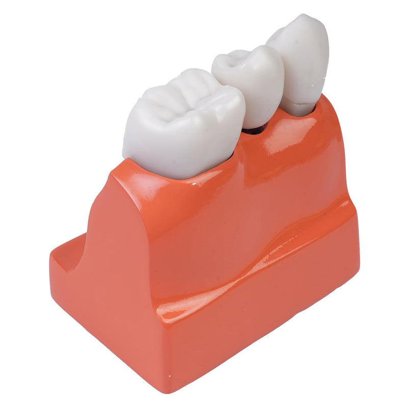 [AUSTRALIA] - Sarini Oral Dental Model, Dental Implant Model with Removable Crown and Bridge, Suitable for Classroom Demonstrations and Dental Student Training 