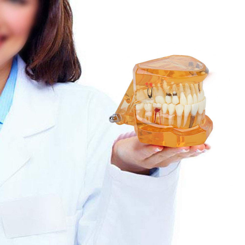 Dental Model for Teaching, Dental Degeneration Model Demonstration Study Orange Model Dentures