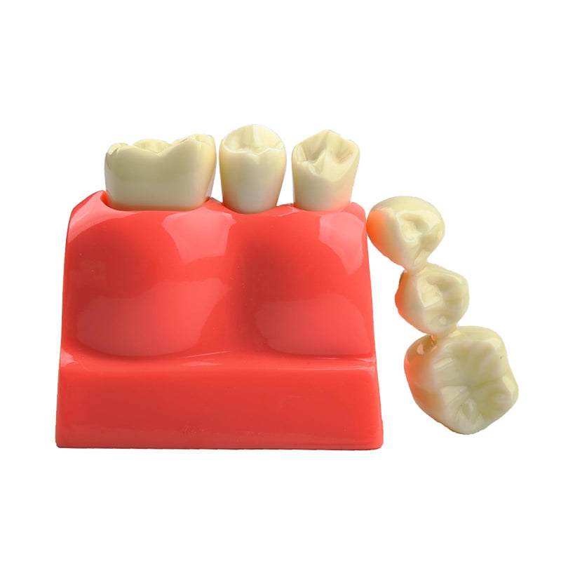 Dental Implant Model Removable Crown Bridge 4 Teeth Demonstration Model for Teaching Demonstration, Patient Education and Student Learning