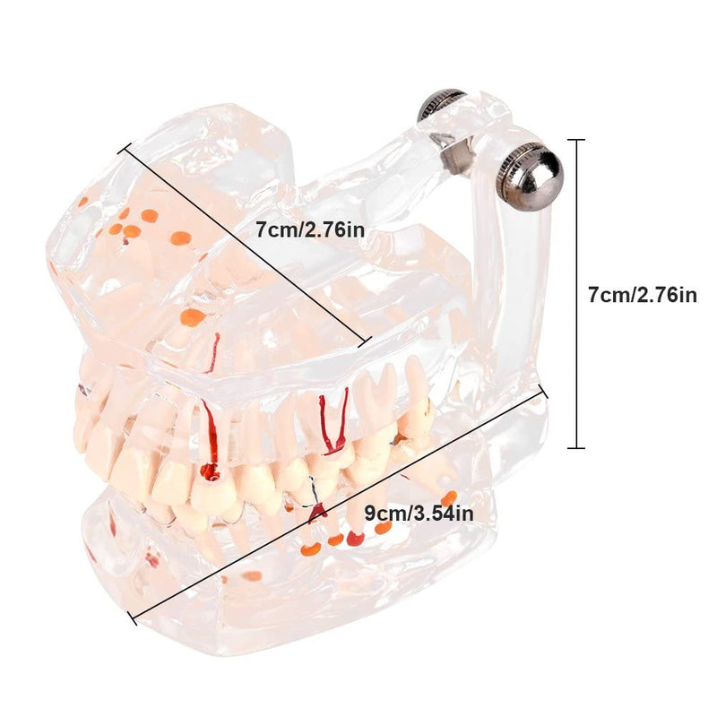 Walfront Model with removable teeth, transparent, implant, disease, teaching, standard teeth, model pathological demonstration