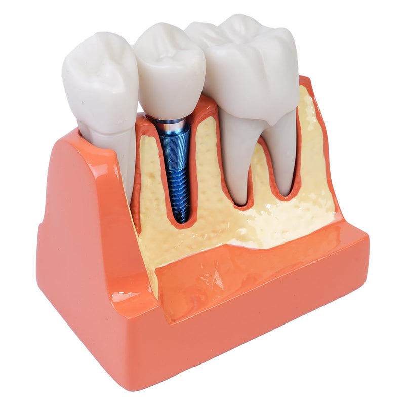 [AUSTRALIA] - Sarini Oral Dental Model, Dental Implant Model with Removable Crown and Bridge, Suitable for Classroom Demonstrations and Dental Student Training 