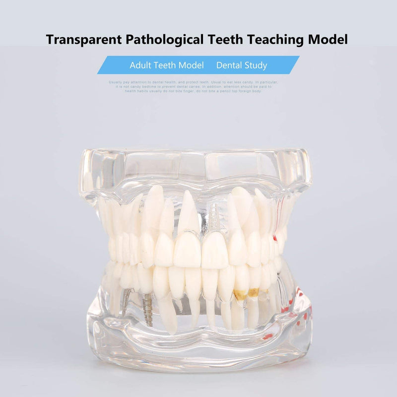 Model of Dentist Training, Dental Implant Disease Teaching Study Analysis Adult Typodont Demonstration Teeth Model New