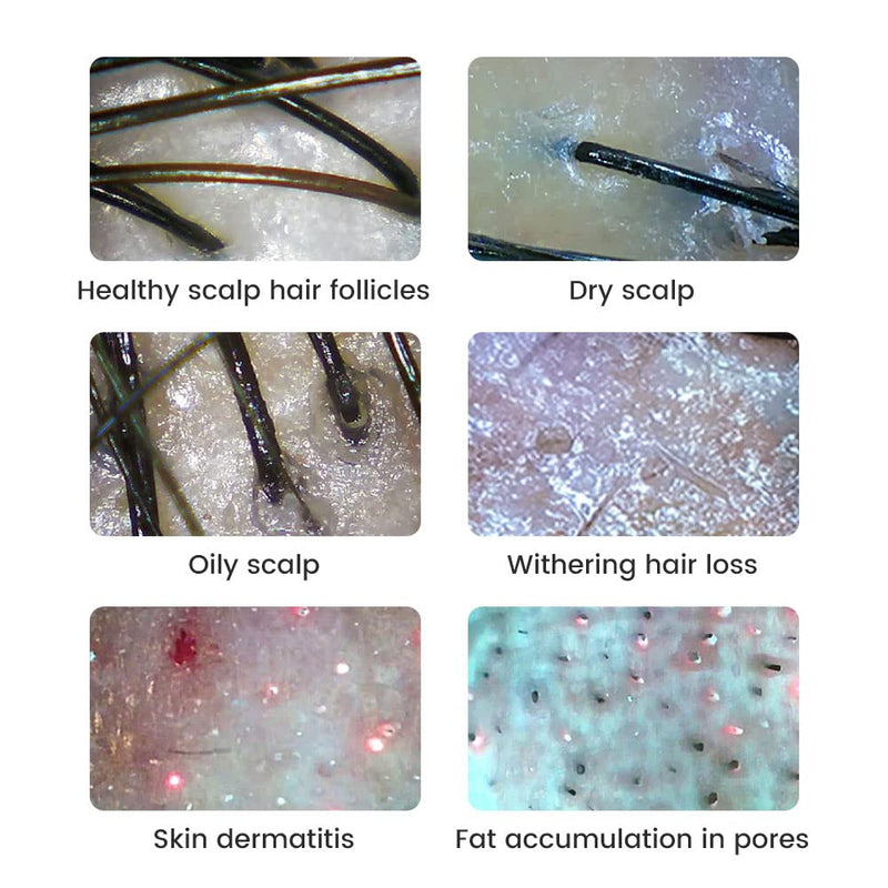 [AUSTRALIA] - Handheld Dermatoscope Skin Analyzer Machine, Wireless Portable Digital Microscope with 1080P IPS Screen 8 LEDs, 500X Magnifier, for Scalp/Hair Trichomes Facial Skin Dermatoscope Black-Dual Mirror 