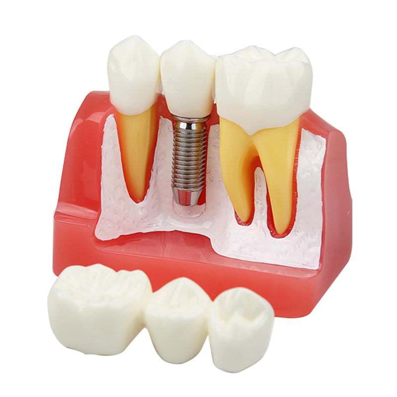 Dental Implant Model Removable Crown Bridge 4 Teeth Demonstration Model for Teaching Demonstration, Patient Education and Student Learning