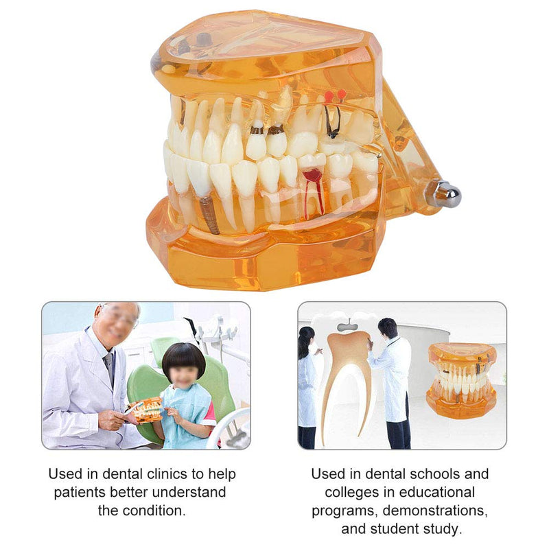 Dental Model for Teaching, Dental Degeneration Model Demonstration Study Orange Model Dentures