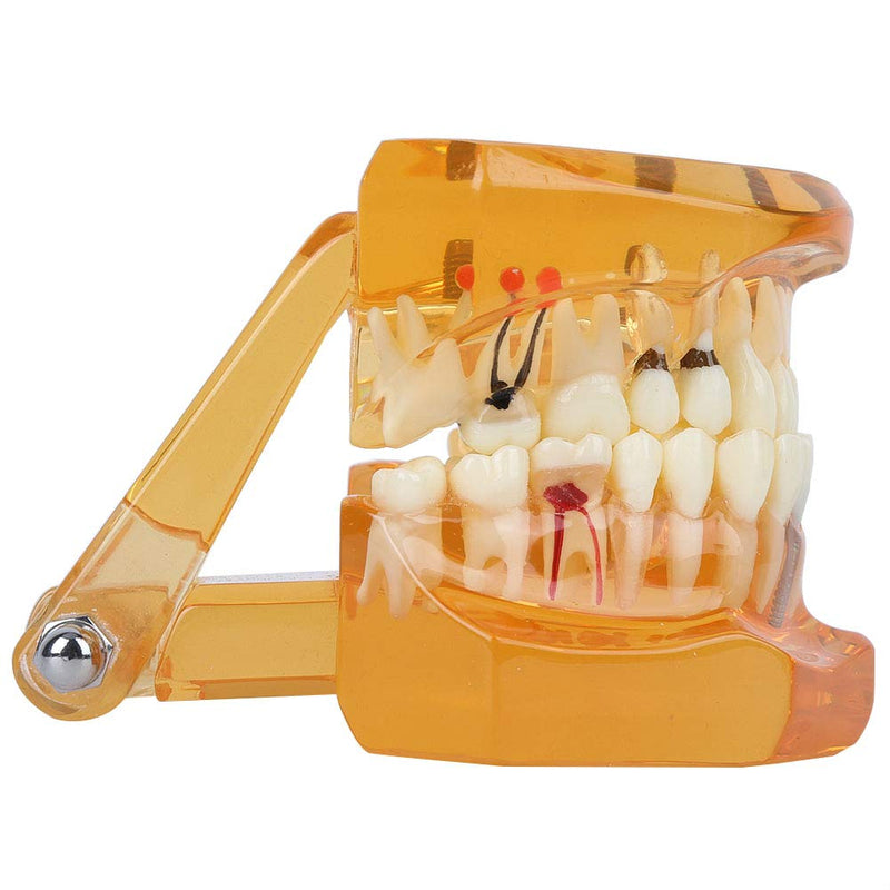Dental Model for Teaching, Dental Degeneration Model Demonstration Study Orange Model Dentures