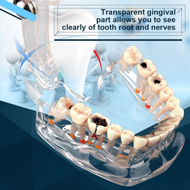 Walfront Model with removable teeth, transparent, implant, disease, teaching, standard teeth, model pathological demonstration