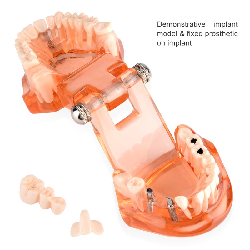 Dental Model for Teaching, Dental Degeneration Model Demonstration Study Orange Model Dentures