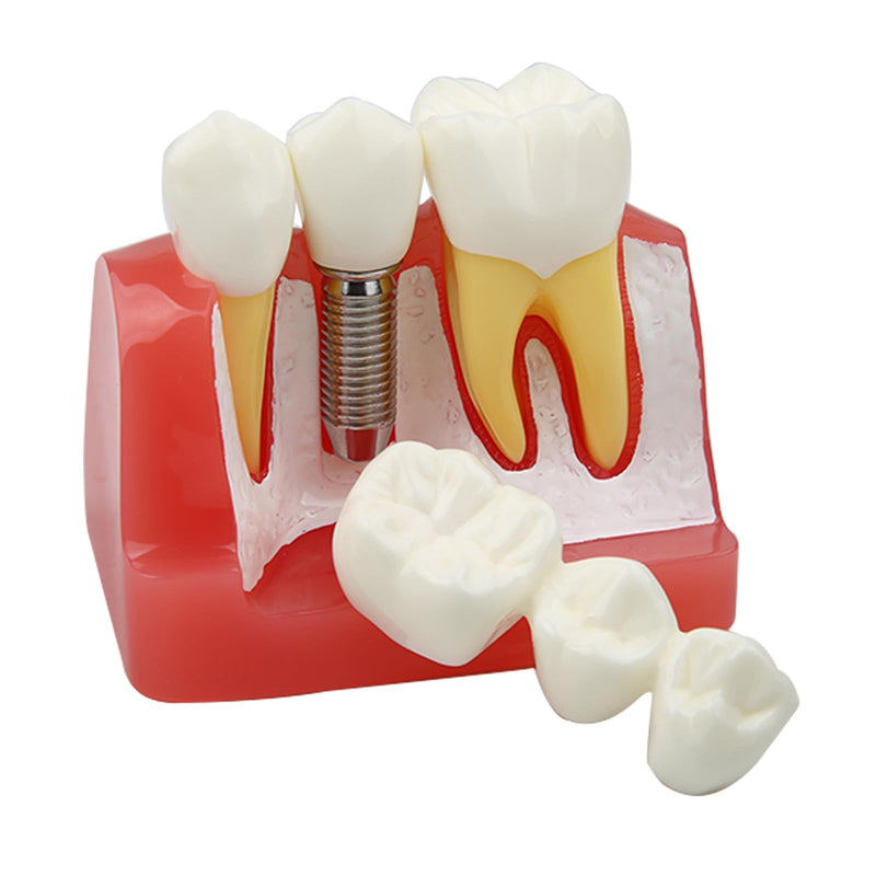 Dental Implant Model Removable Crown Bridge 4 Teeth Demonstration Model for Teaching Demonstration, Patient Education and Student Learning
