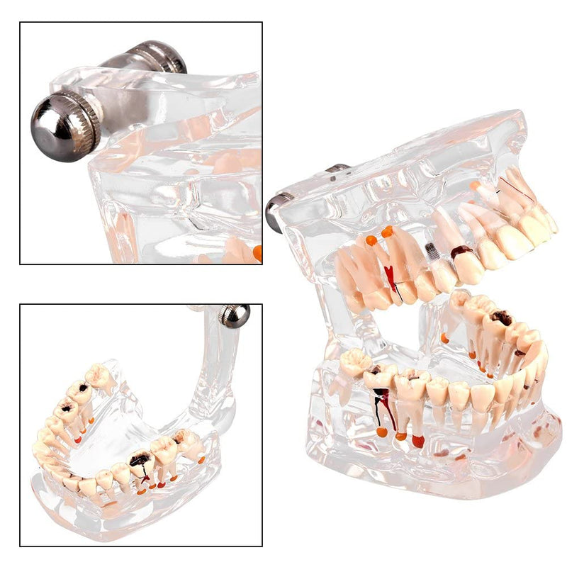 Walfront Model with removable teeth, transparent, implant, disease, teaching, standard teeth, model pathological demonstration