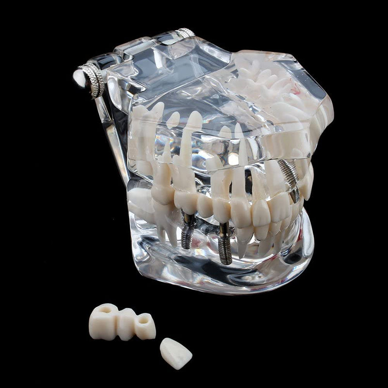 Model of Dentist Training, Dental Implant Disease Teaching Study Analysis Adult Typodont Demonstration Teeth Model New