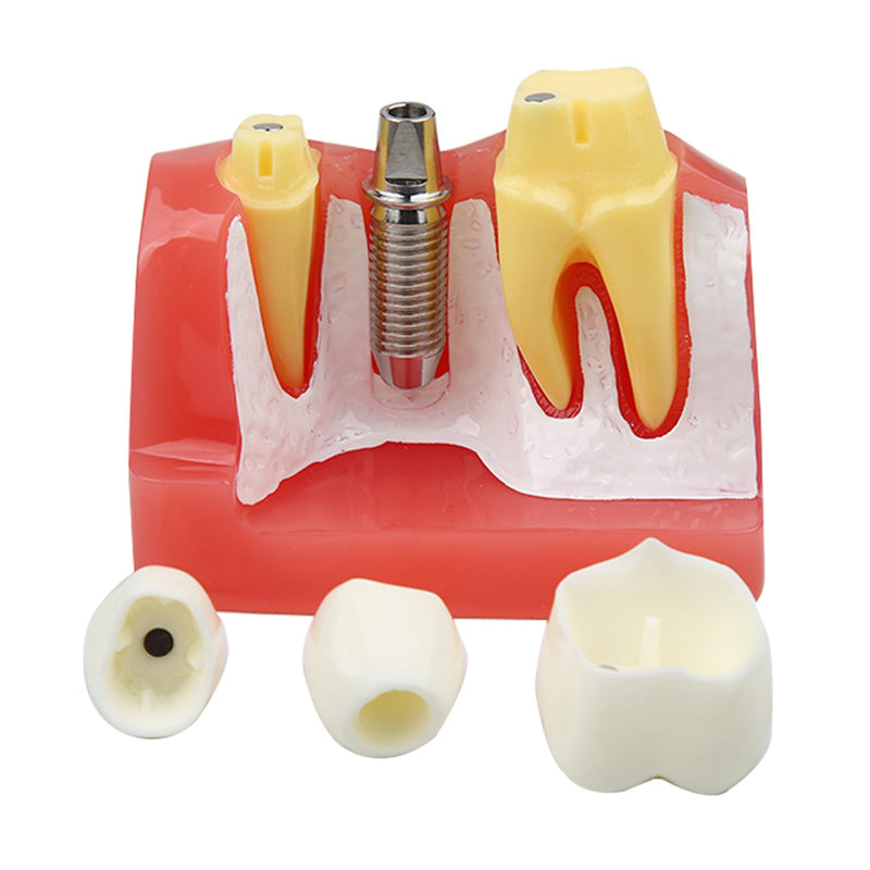 Dental Implant Model Removable Crown Bridge 4 Teeth Demonstration Model for Teaching Demonstration, Patient Education and Student Learning