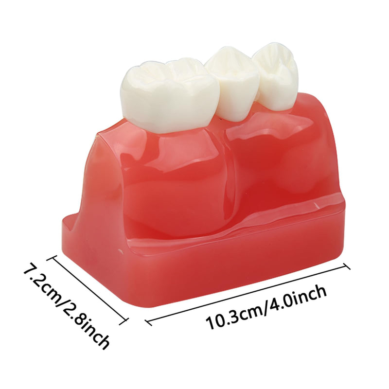 Dental Implant Model Removable Crown Bridge 4 Teeth Demonstration Model for Teaching Demonstration, Patient Education and Student Learning