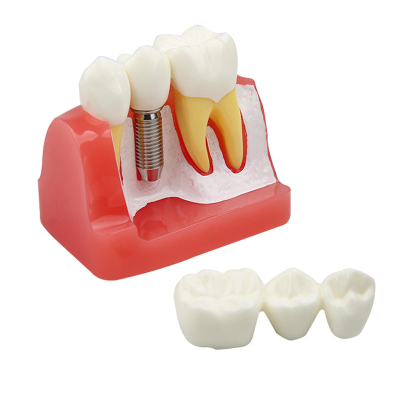 Dental Implant Model Removable Crown Bridge 4 Teeth Demonstration Model for Teaching Demonstration, Patient Education and Student Learning