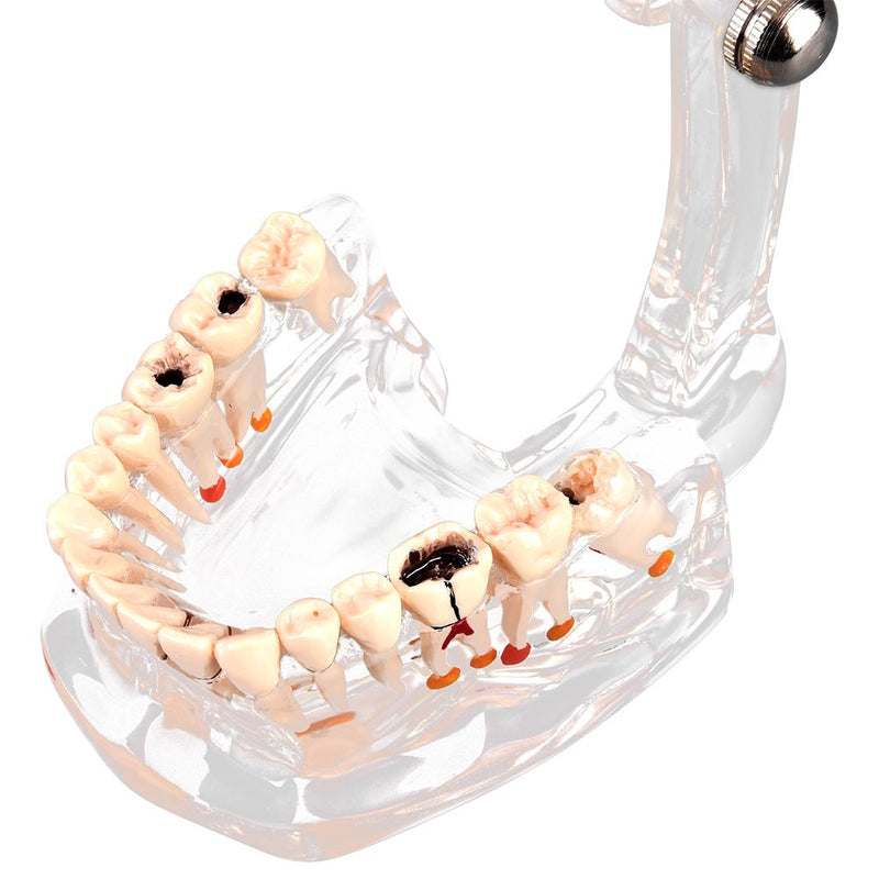 Walfront Model with removable teeth, transparent, implant, disease, teaching, standard teeth, model pathological demonstration