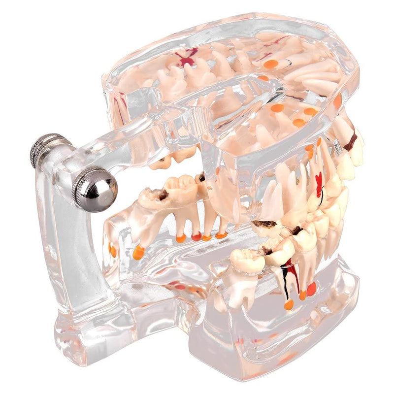 Walfront Model with removable teeth, transparent, implant, disease, teaching, standard teeth, model pathological demonstration