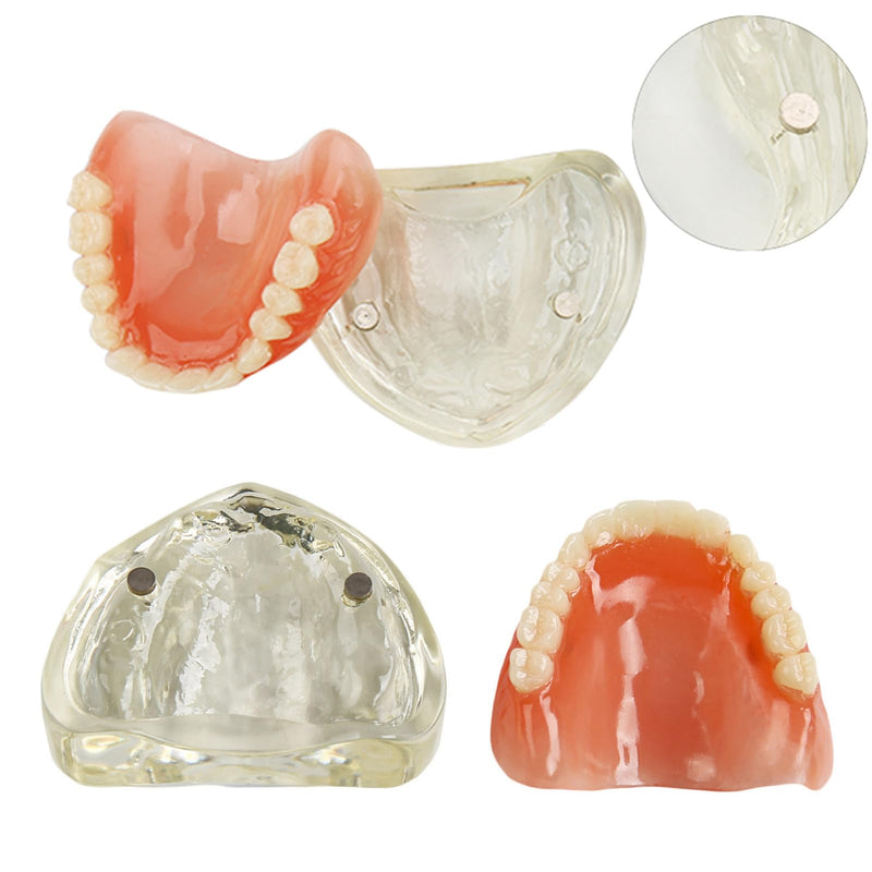 Dental Model Upper Jaw Deck Prosthesis with 2 Implants for Training and Study (Upper Jaw)