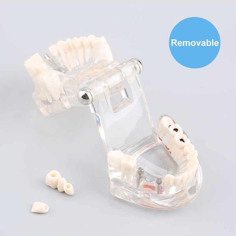 Model of Dentist Training, Dental Implant Disease Teaching Study Analysis Adult Typodont Demonstration Teeth Model New
