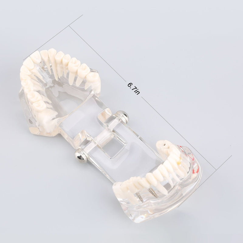 Model of Dentist Training, Dental Implant Disease Teaching Study Analysis Adult Typodont Demonstration Teeth Model New
