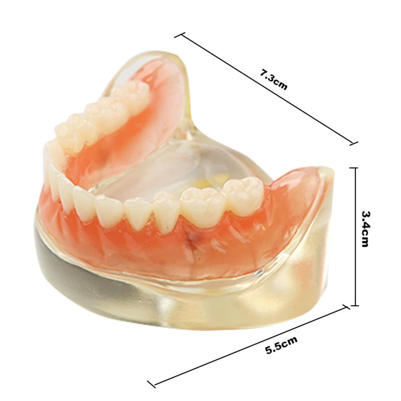 Dental Model Upper Jaw Deck Prosthesis with 2 Implants for Training and Study (Upper Jaw)
