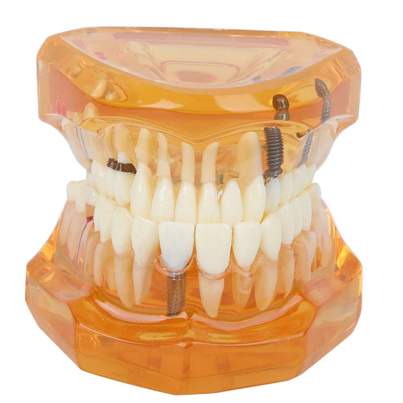 Dental Model for Teaching, Dental Degeneration Model Demonstration Study Orange Model Dentures