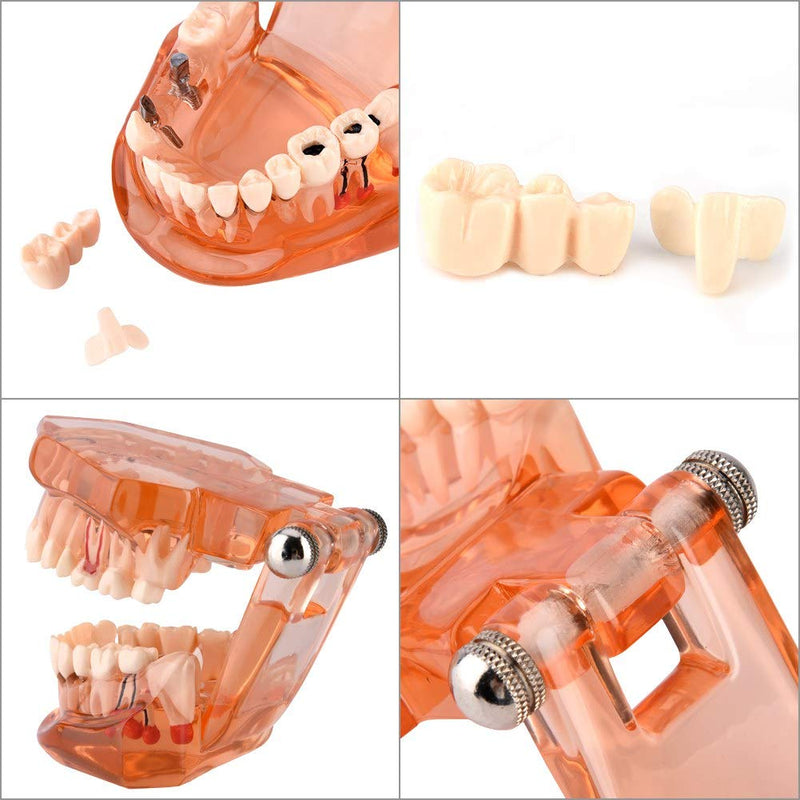 Dental Model for Teaching, Dental Degeneration Model Demonstration Study Orange Model Dentures