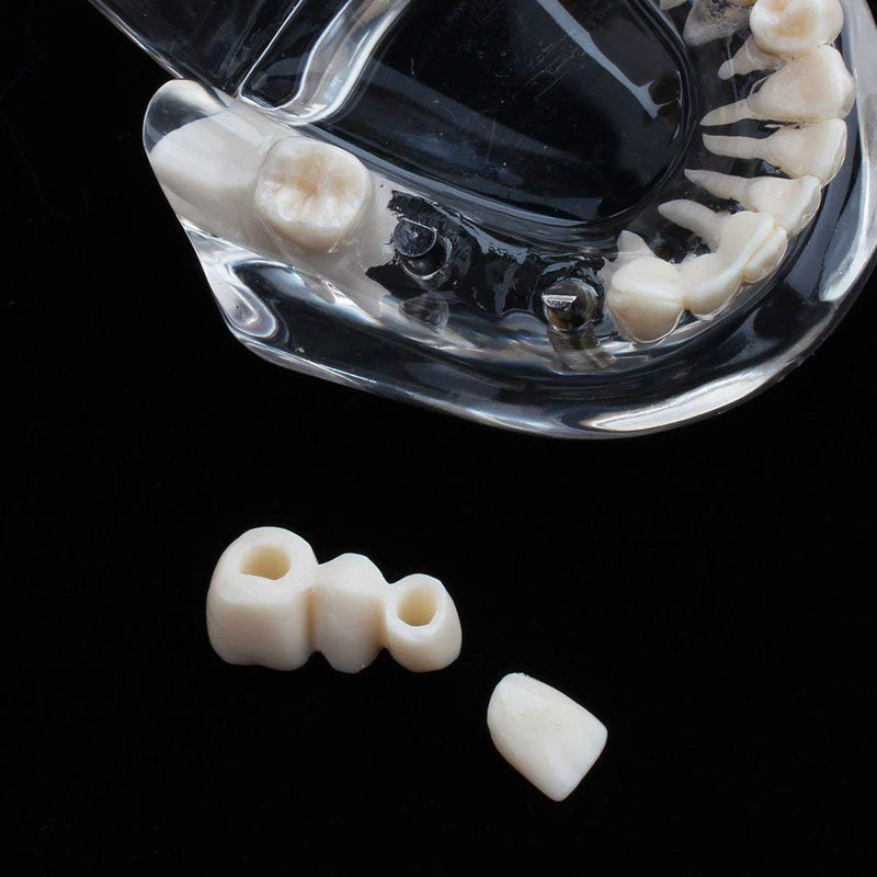 Model of Dentist Training, Dental Implant Disease Teaching Study Analysis Adult Typodont Demonstration Teeth Model New