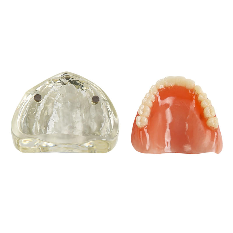 Dental Model Upper Jaw Deck Prosthesis with 2 Implants for Training and Study (Upper Jaw)