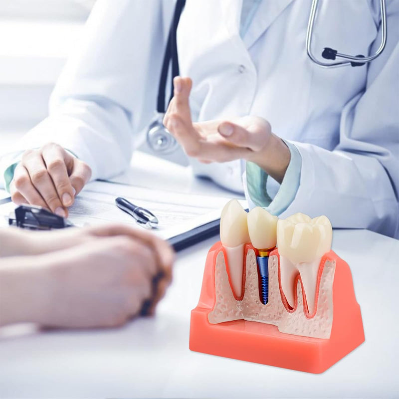 [AUSTRALIA] - Sarini Oral Dental Model, Dental Implant Model with Removable Crown and Bridge, Suitable for Classroom Demonstrations and Dental Student Training 