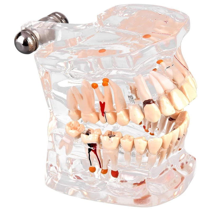 Walfront Model with removable teeth, transparent, implant, disease, teaching, standard teeth, model pathological demonstration