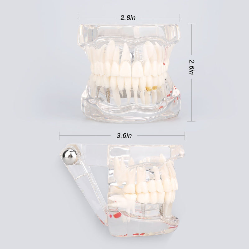 Model of Dentist Training, Dental Implant Disease Teaching Study Analysis Adult Typodont Demonstration Teeth Model New
