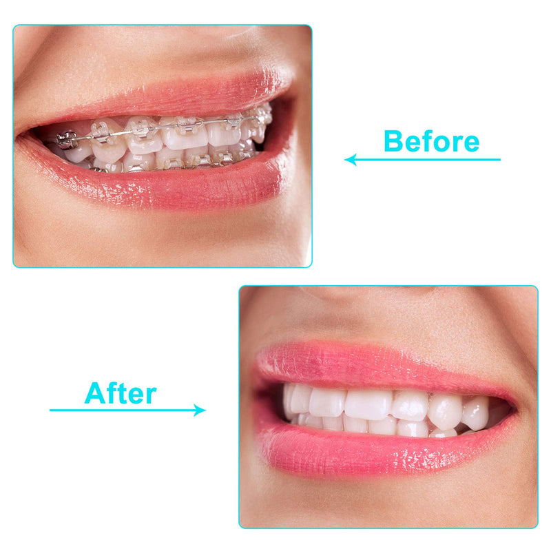 BBTO 60 Pieces Aligner Tray Seaters for Chompers Orthodontic Aligner, 6 Colors