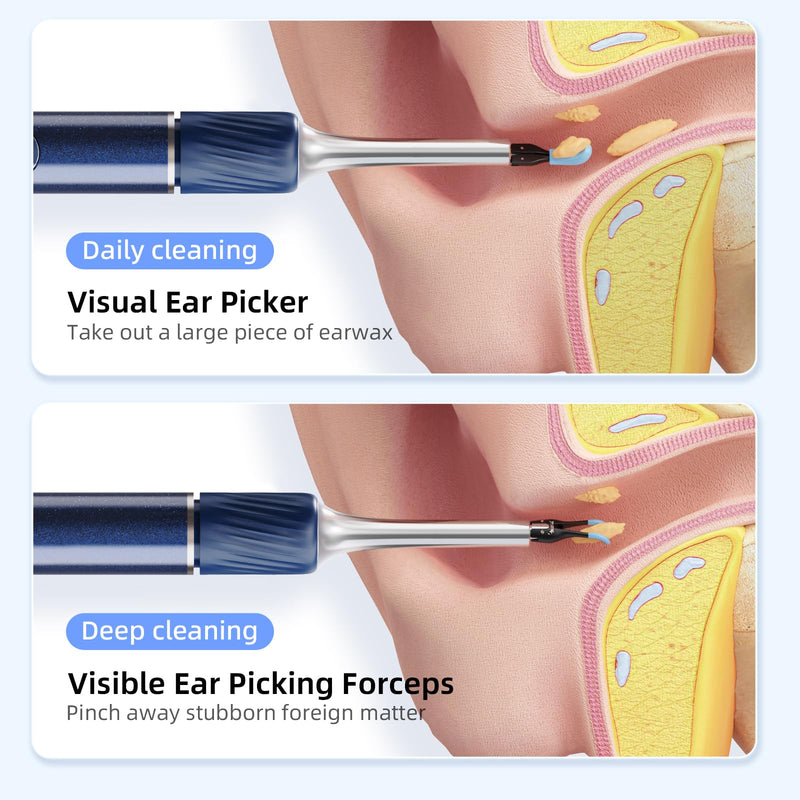Qimic Ear Wax Remover Otoscope, 1080P HD WiFi Ear Cleaner, Ear Camera with Tweezers & 4 LEDs, Otoscope for iOS & Android, IP67 Waterproof Ear Cleaner for Adults, Children and Pets S8 blue