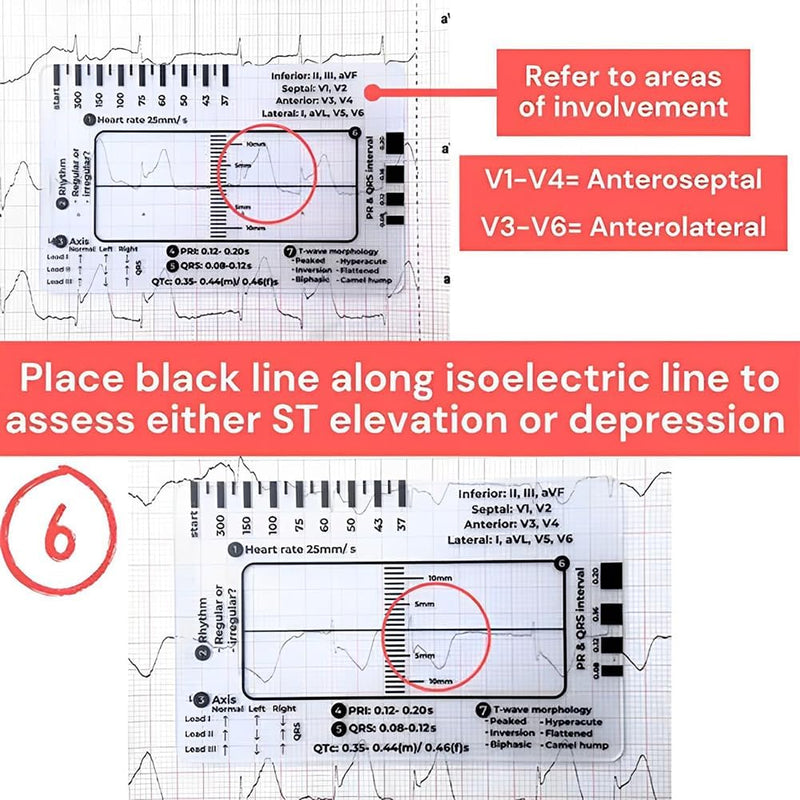 ECG 7 Step Ruler, ECG 7 Step Ruler for ECG/EKG Interpretation, ECG Ruler Plastic Ruler Measuring Tool, ECG Ruler Transparent, ECG Ruler Pocket etcard, Easy-to-Carry ECG Ruler (2 Pieces (with box))