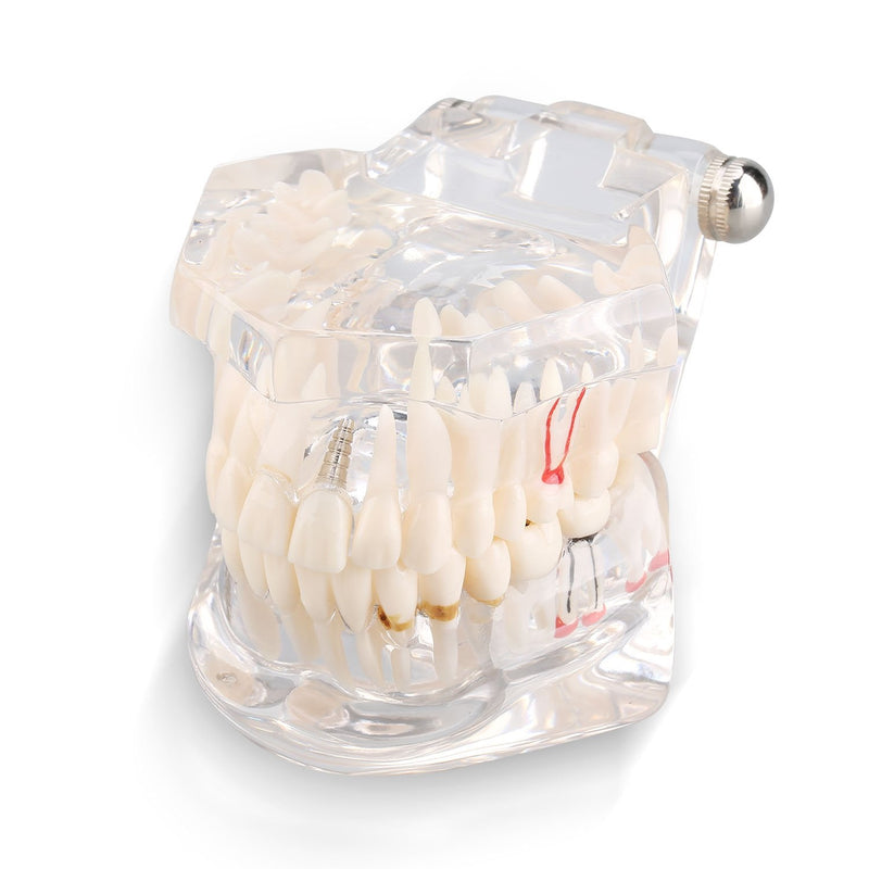 Model of Dentist Training, Dental Implant Disease Teaching Study Analysis Adult Typodont Demonstration Teeth Model New