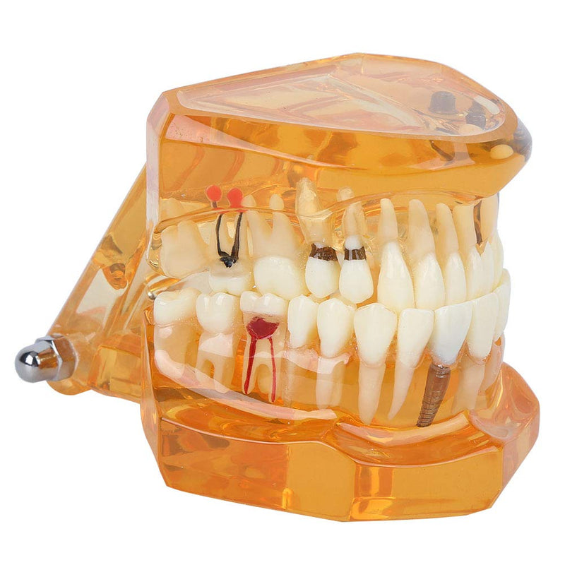 Dental Model for Teaching, Dental Degeneration Model Demonstration Study Orange Model Dentures