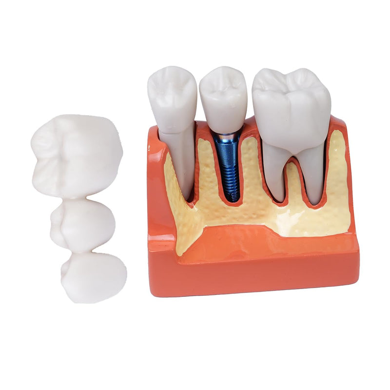 [AUSTRALIA] - Sarini Oral Dental Model, Dental Implant Model with Removable Crown and Bridge, Suitable for Classroom Demonstrations and Dental Student Training 