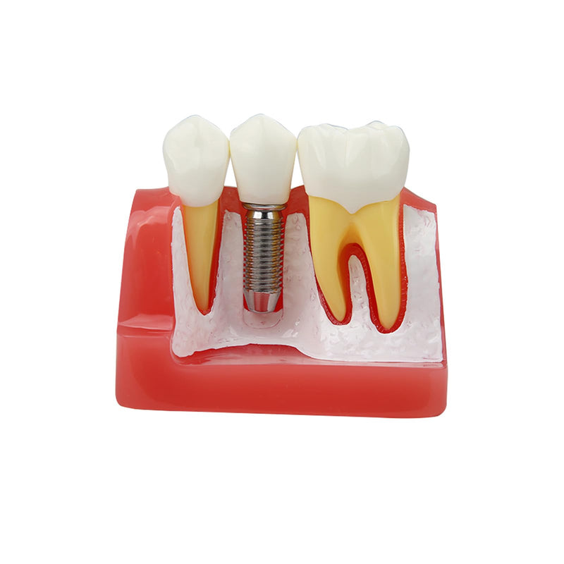 Dental Implant Model Removable Crown Bridge 4 Teeth Demonstration Model for Teaching Demonstration, Patient Education and Student Learning